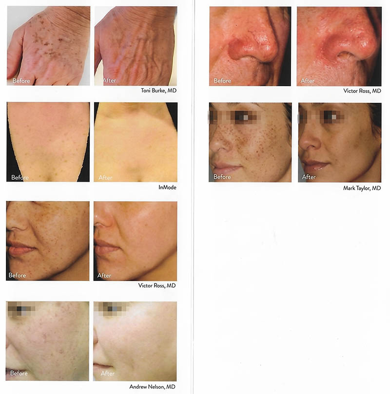before and after lumecca ipl laser miami